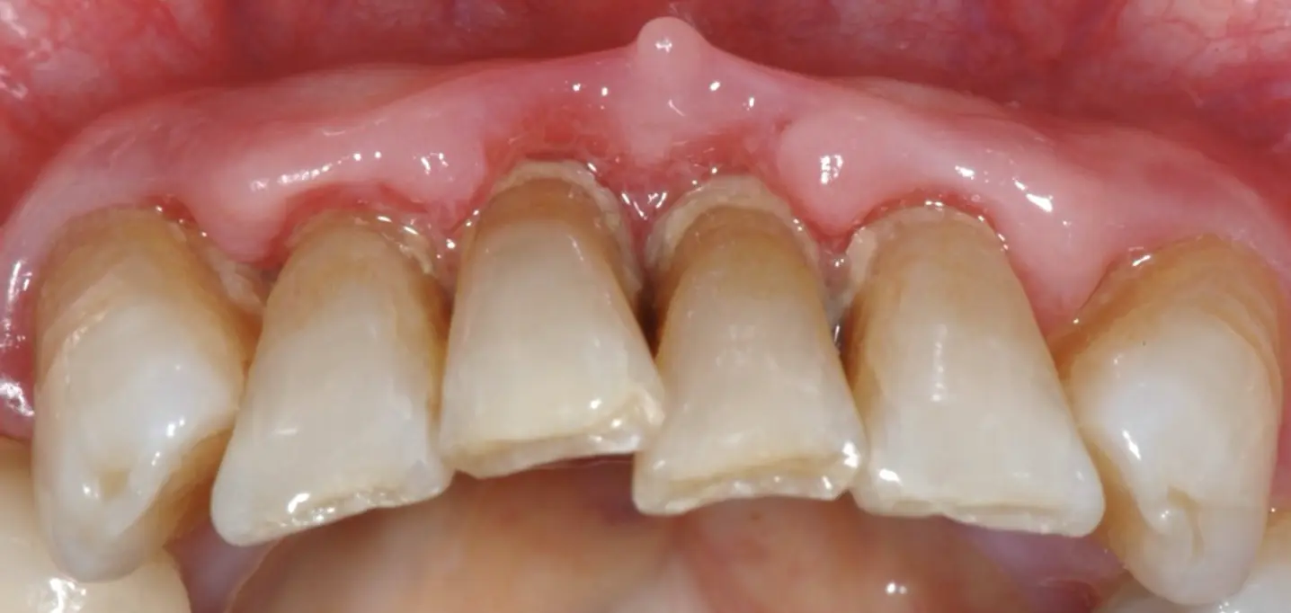 Gingivitis. Entwicklung des Zahnfleisches vor und nach der Behandlung