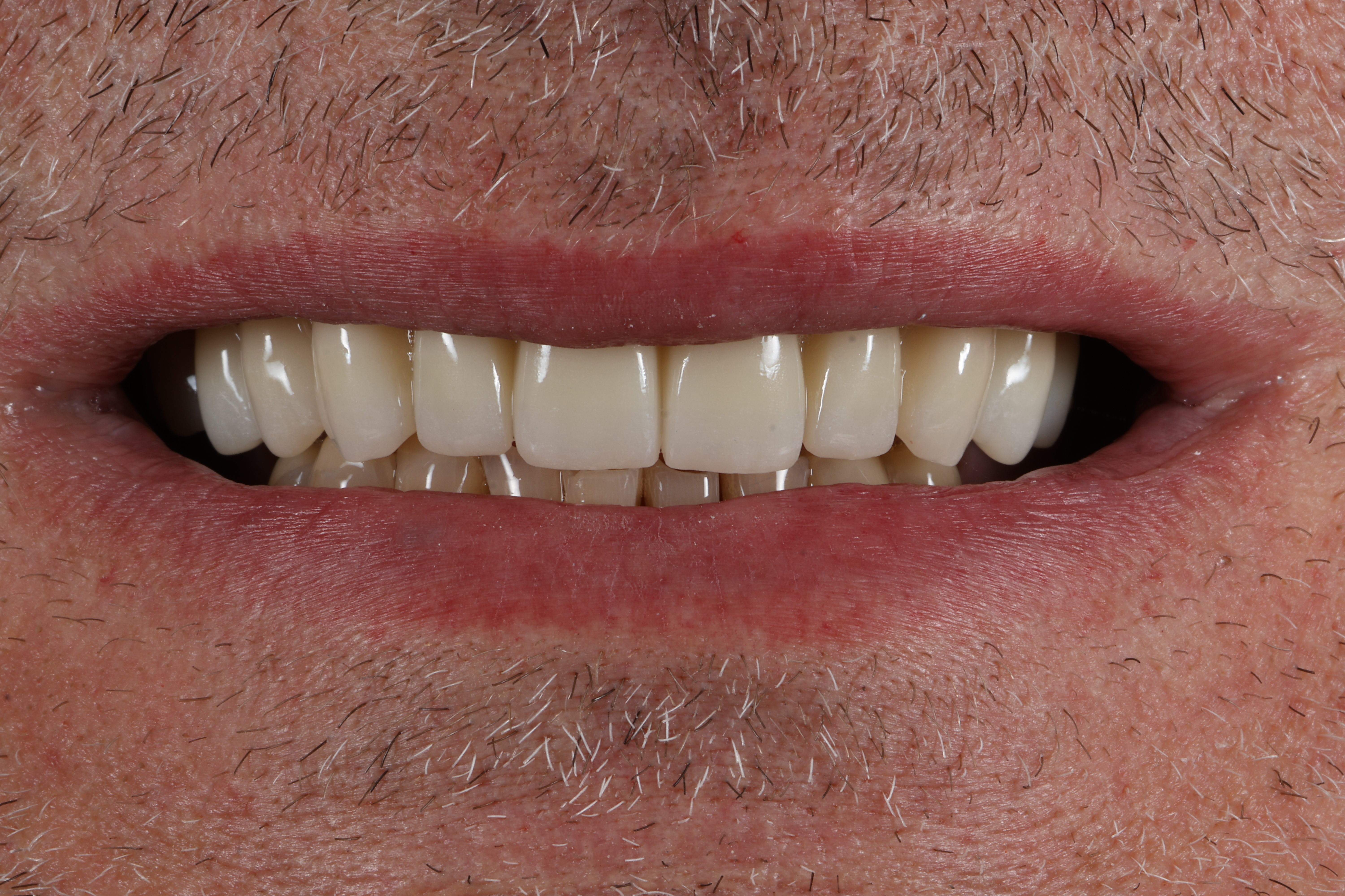 Zirconia Bridges, Smile redesign, Full mouth rehabilitation - after treatment