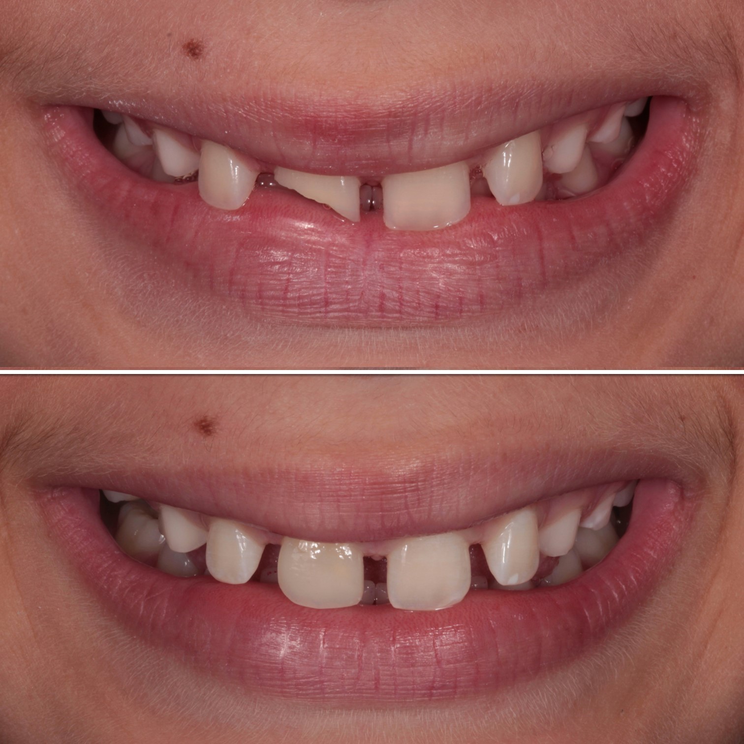 Fotos antes e depois de um sorriso.