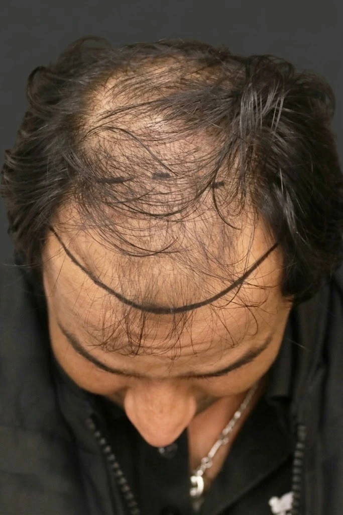 Präoperative Anzeichnung der Haarlinie bei lichtem Haar vor der Transpantation