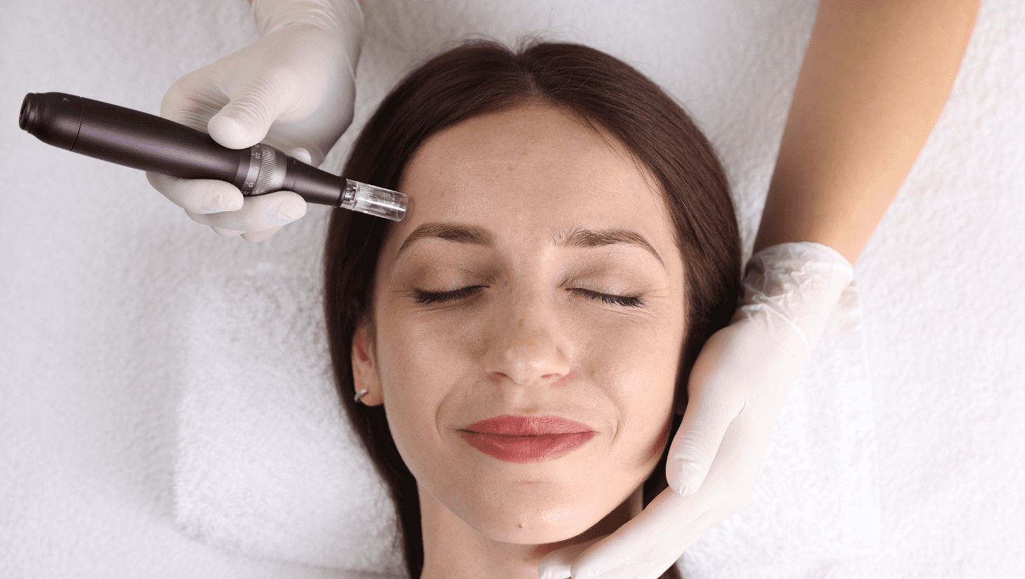 Does Microneedling Actually Work for Acne Scars?