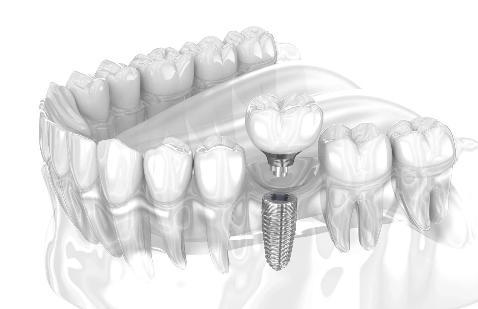 dental implants in smyrna