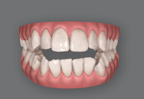 Open bite can be treated with invisible braces (invisalign)