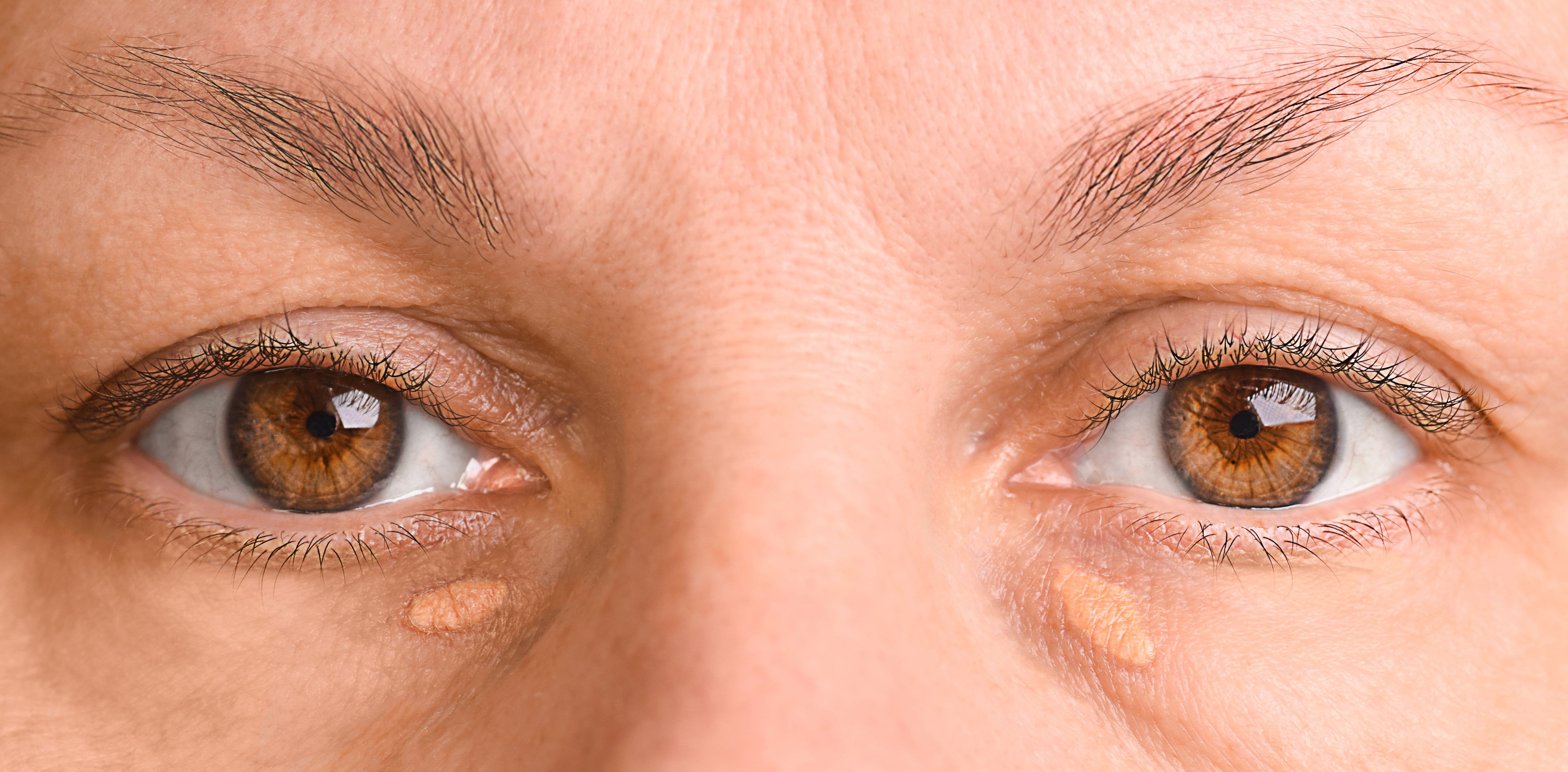 Xanthelasma mit dem Fraxis Duo