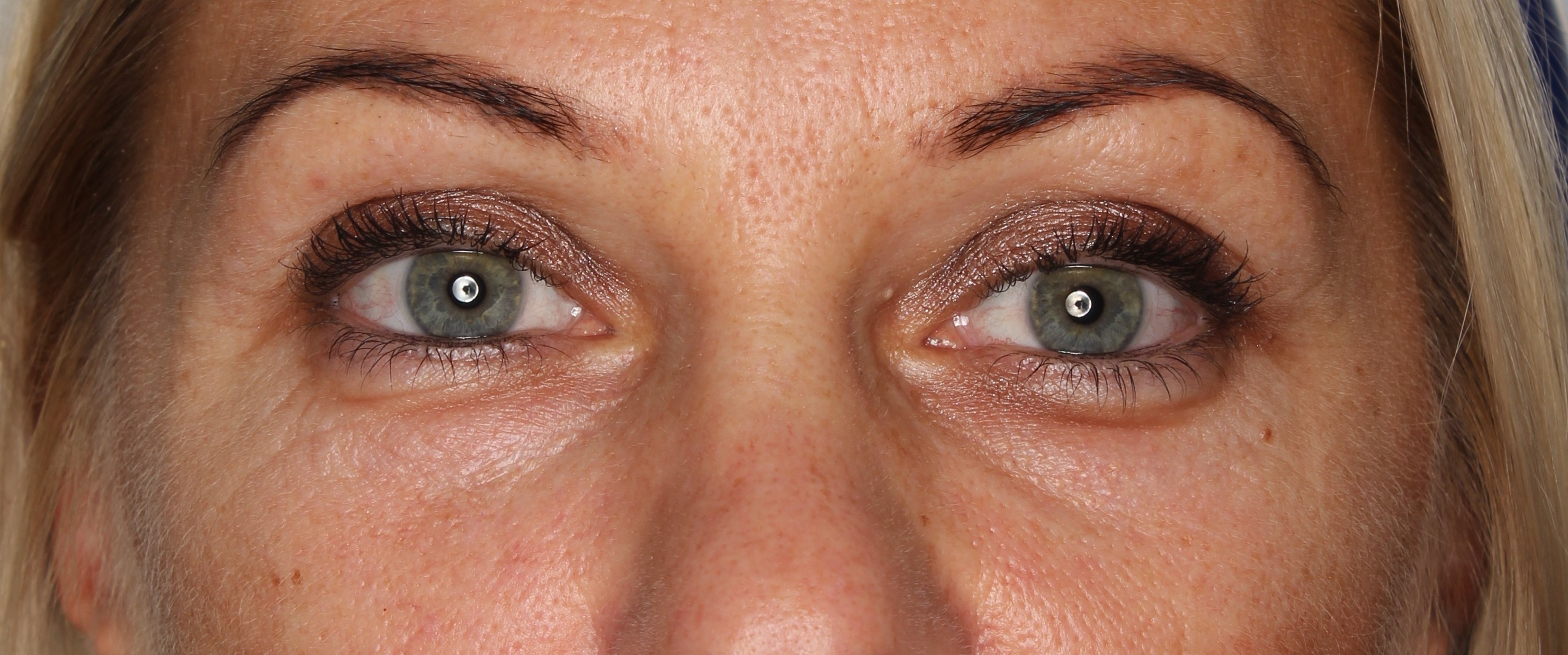 Efekt zabiegu Laser frakcyjny CO2 - Przed 3