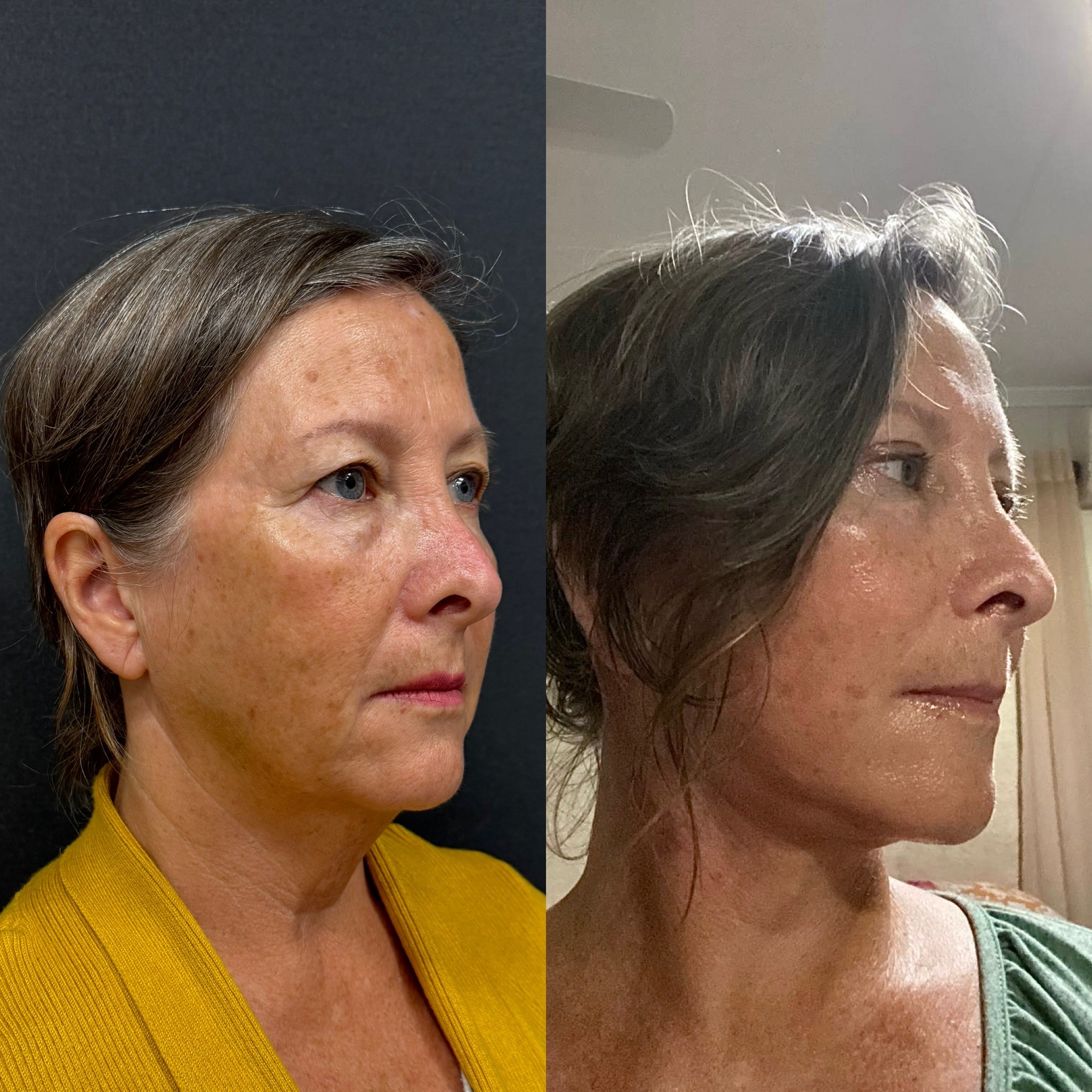 1 month before after deep plane face neck lift right oblique view