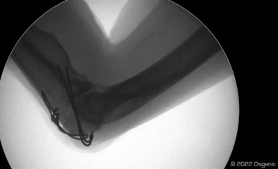 Olecranon fracture - tension band