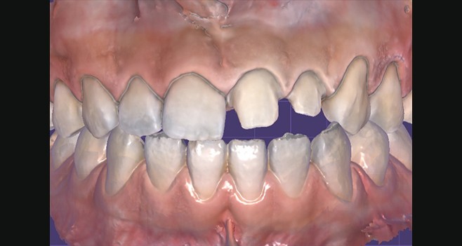 프렙 후 구강 스캔 사진