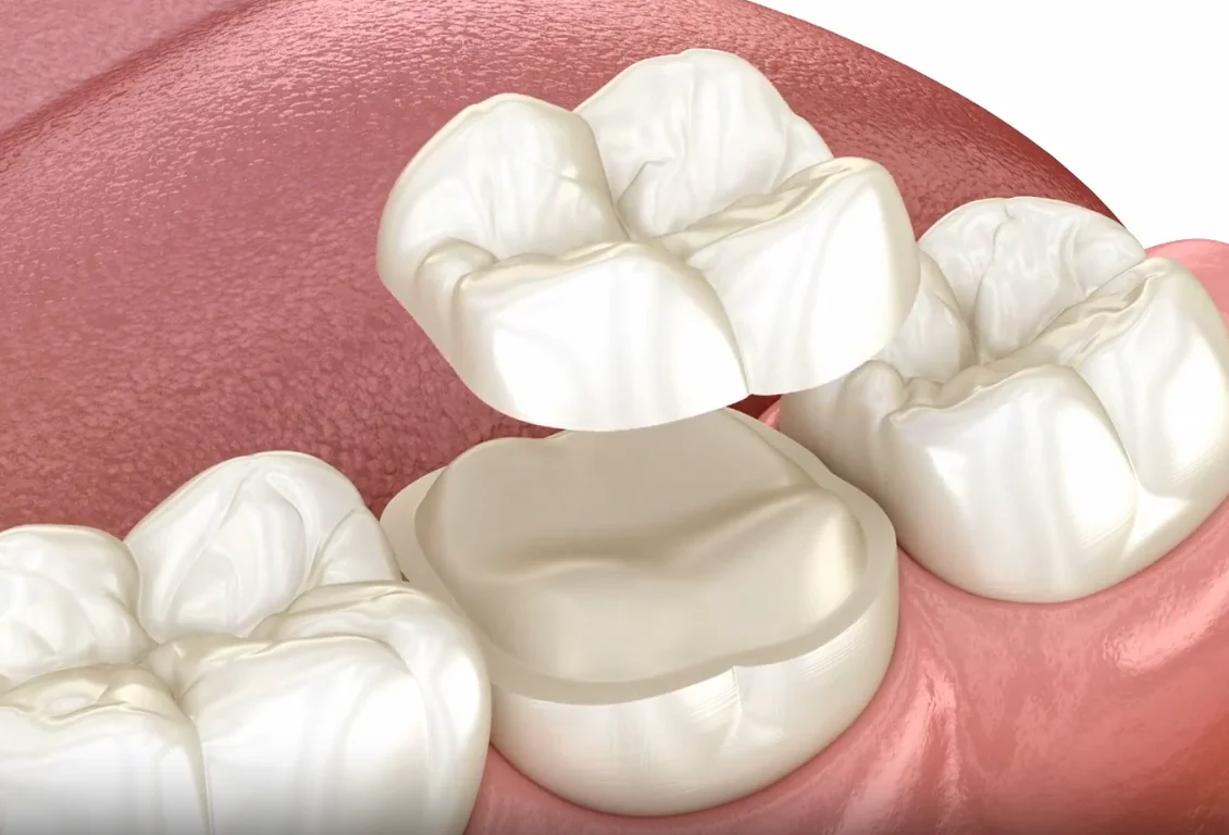 Inlays and onlays treatment information