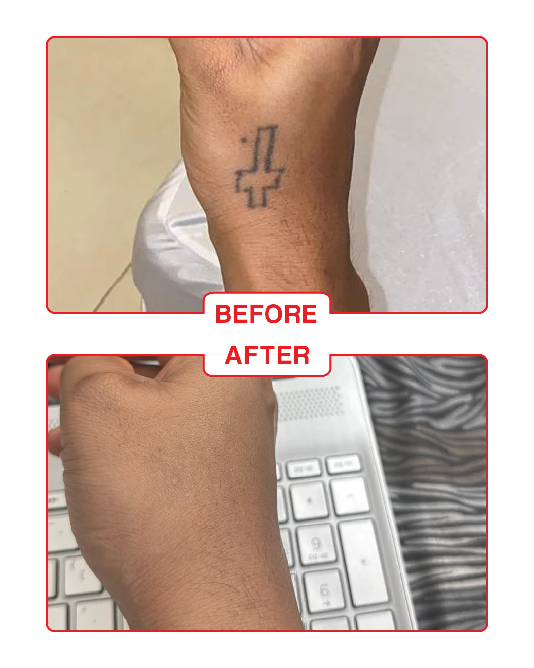 Laser Tattoo removal in Goa