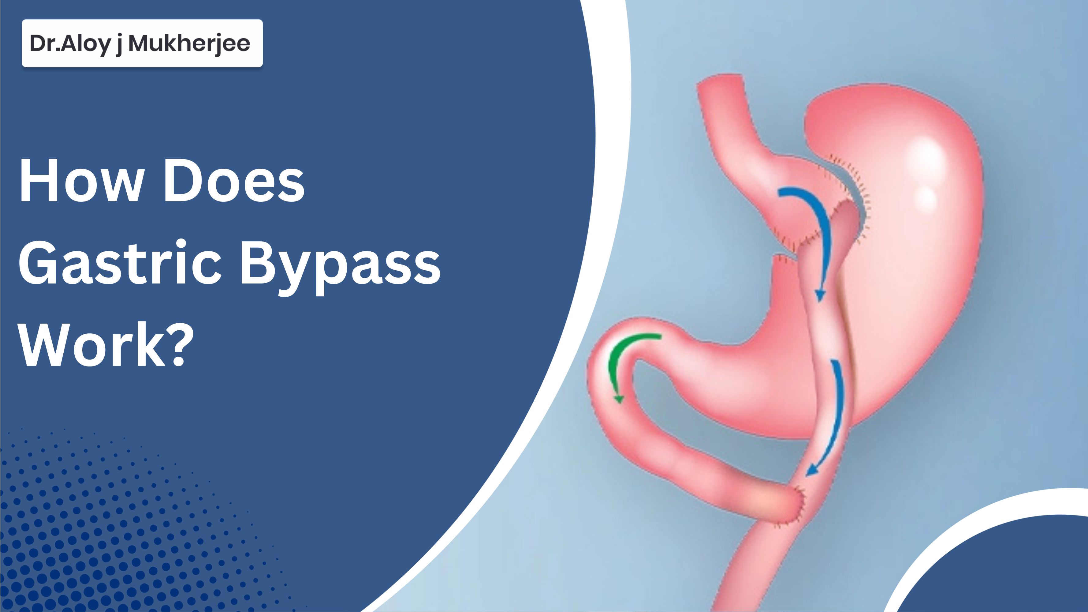 How Does Gastric Bypass Work