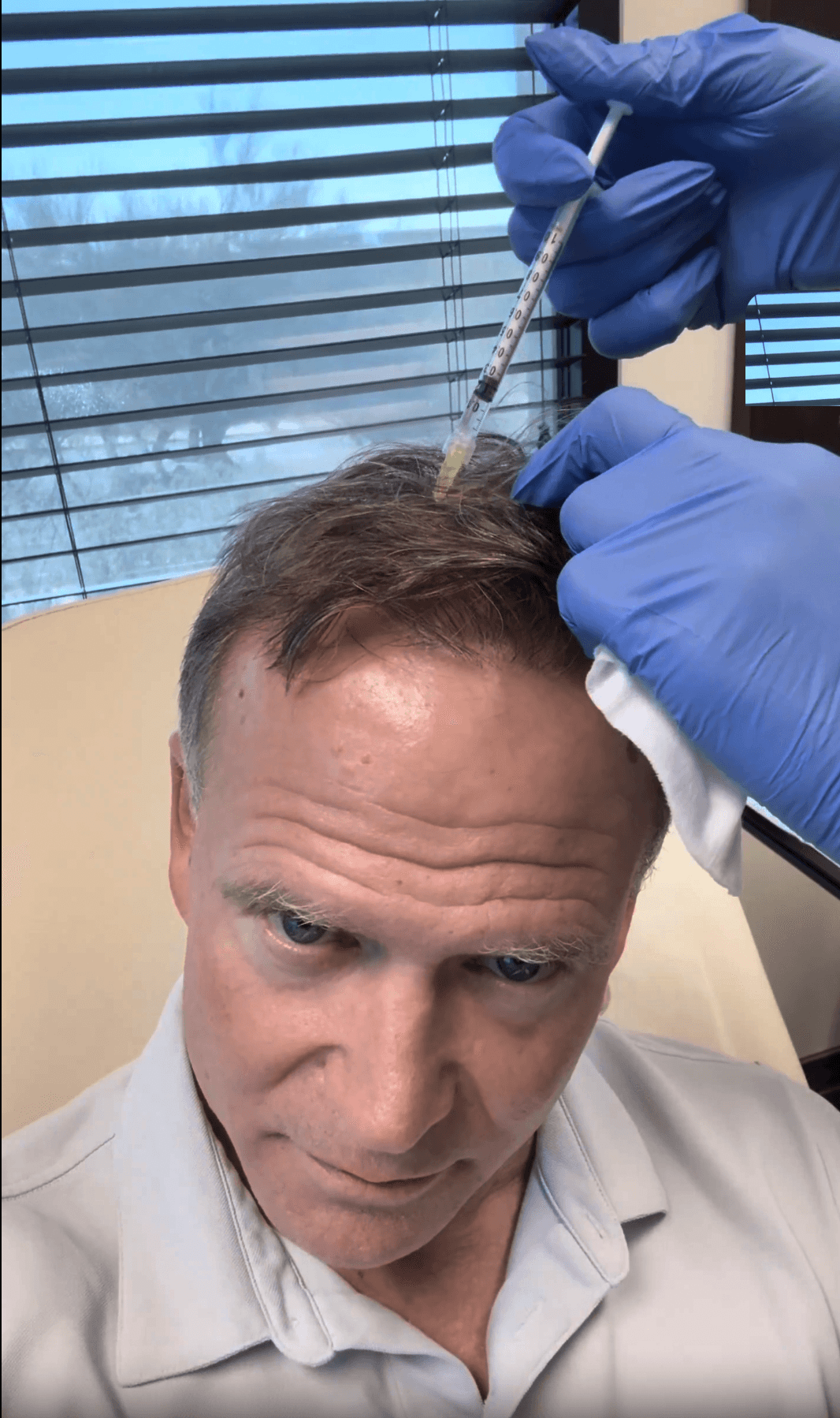 Oklahoma Regenerative Aesthetics Stem Cell Hair Restoration Treatment Photo