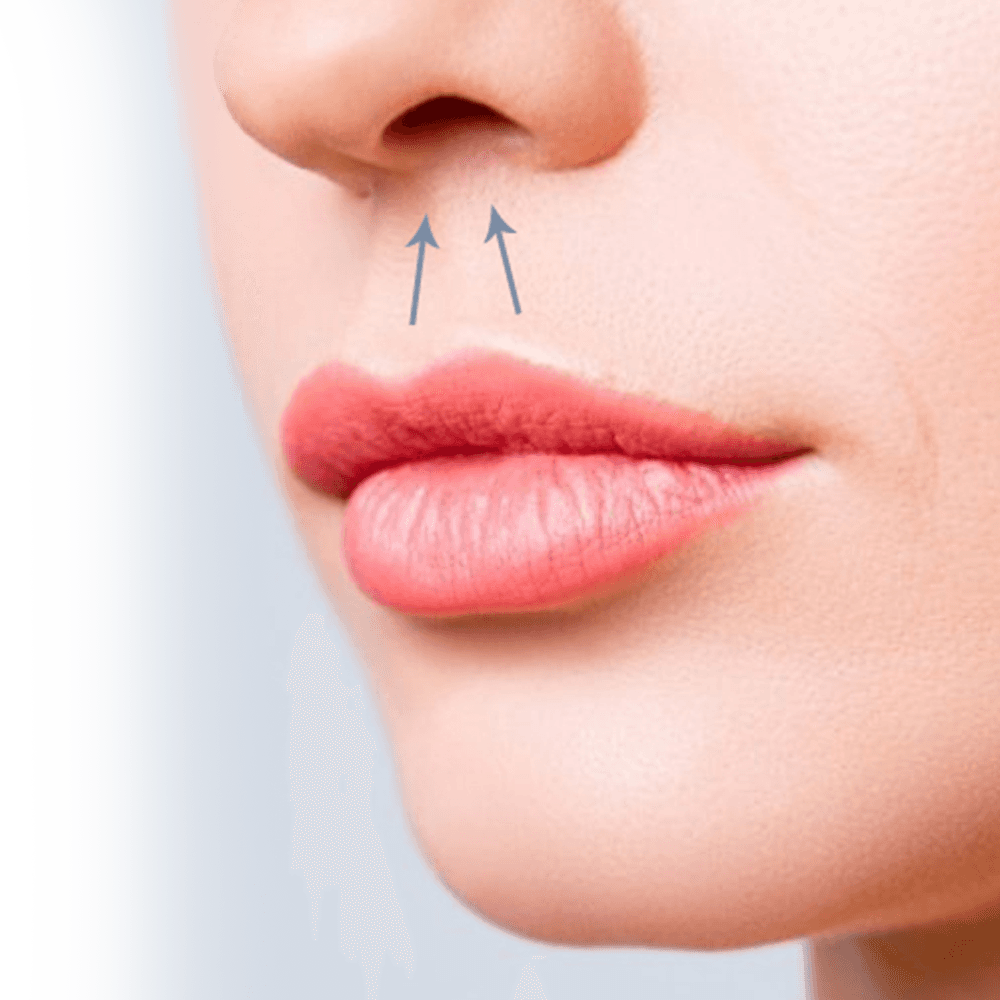 vector of lip lift surgery