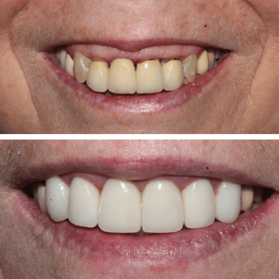 Before and After Crowns at ScarboroSmiles Dental Clinic in Scarborough, ON | Best dentist in Scarborough. 