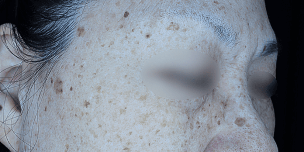 Pigmentation - Before