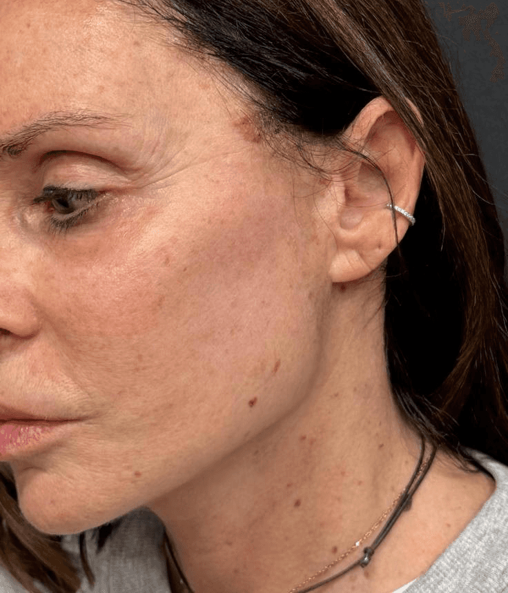 deep plane face and neck lift scar