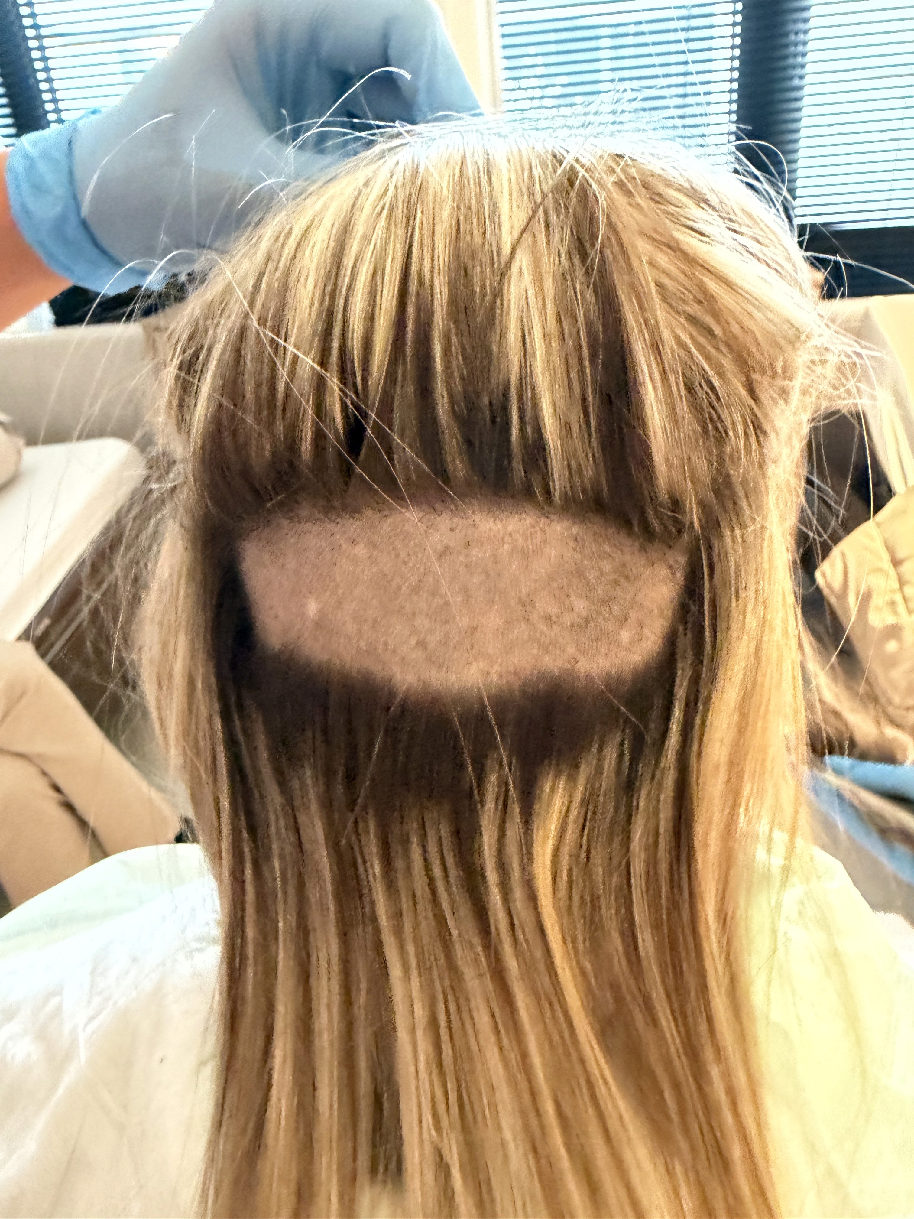 women hair transplantation donor area 