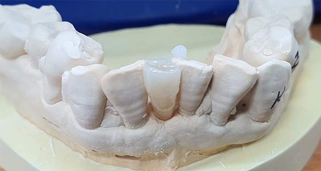 emax 메릴랜드 브릿지 제작