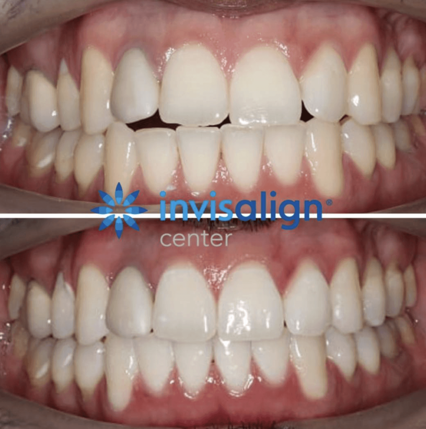 Invisalign® before and after photo of teeth at Invisalign Center in Dubai, highlighting the successful treatment of an open bite.