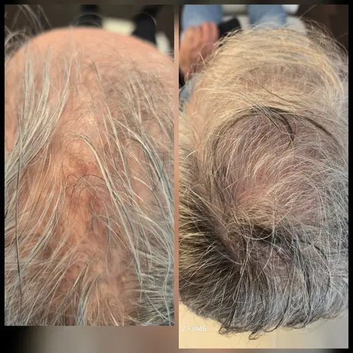 Medicinsk och naturlig behandling för hårväxt med prp behandling