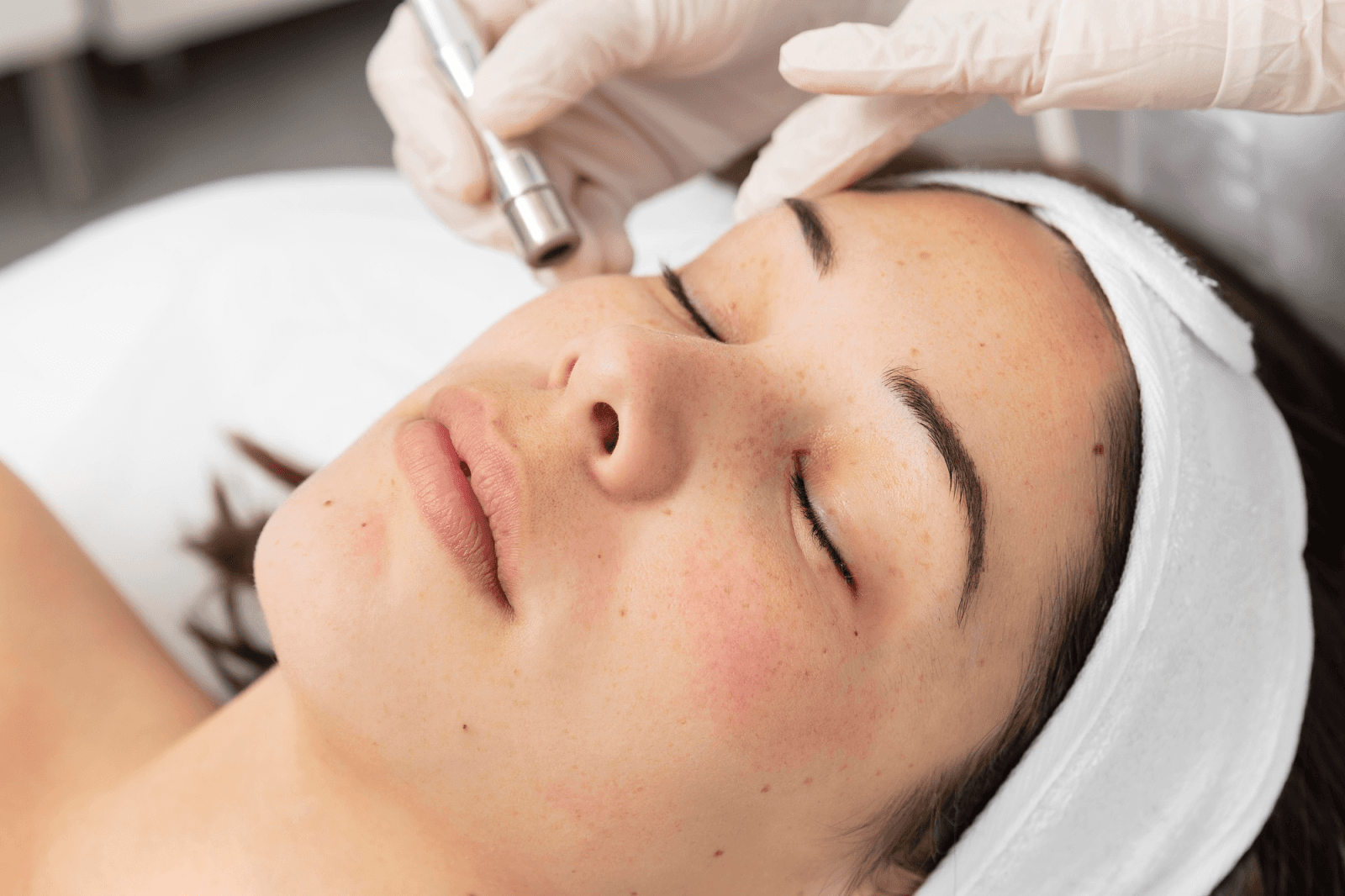 Woman receiving a professional skin pigmentation treatment at a skincare clinic.