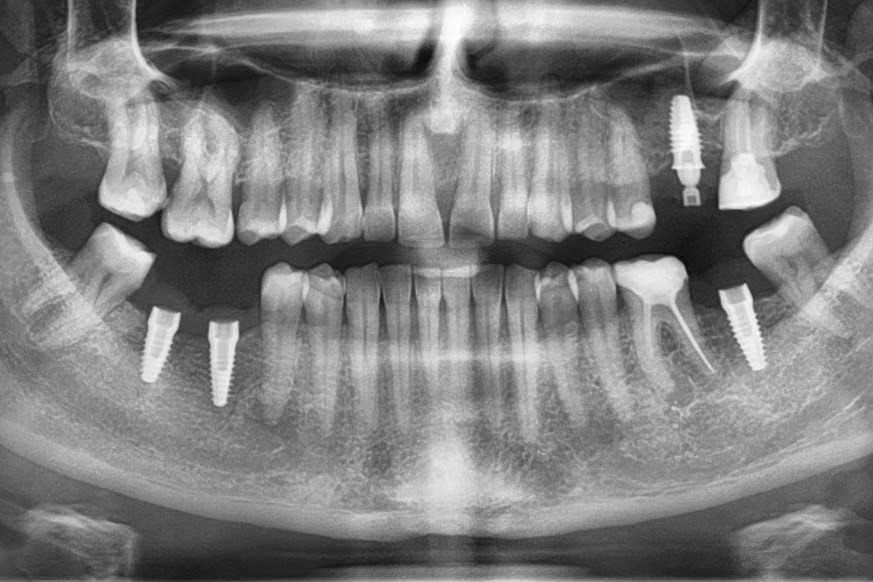 Fogászati Implantátum Tájékoztató
