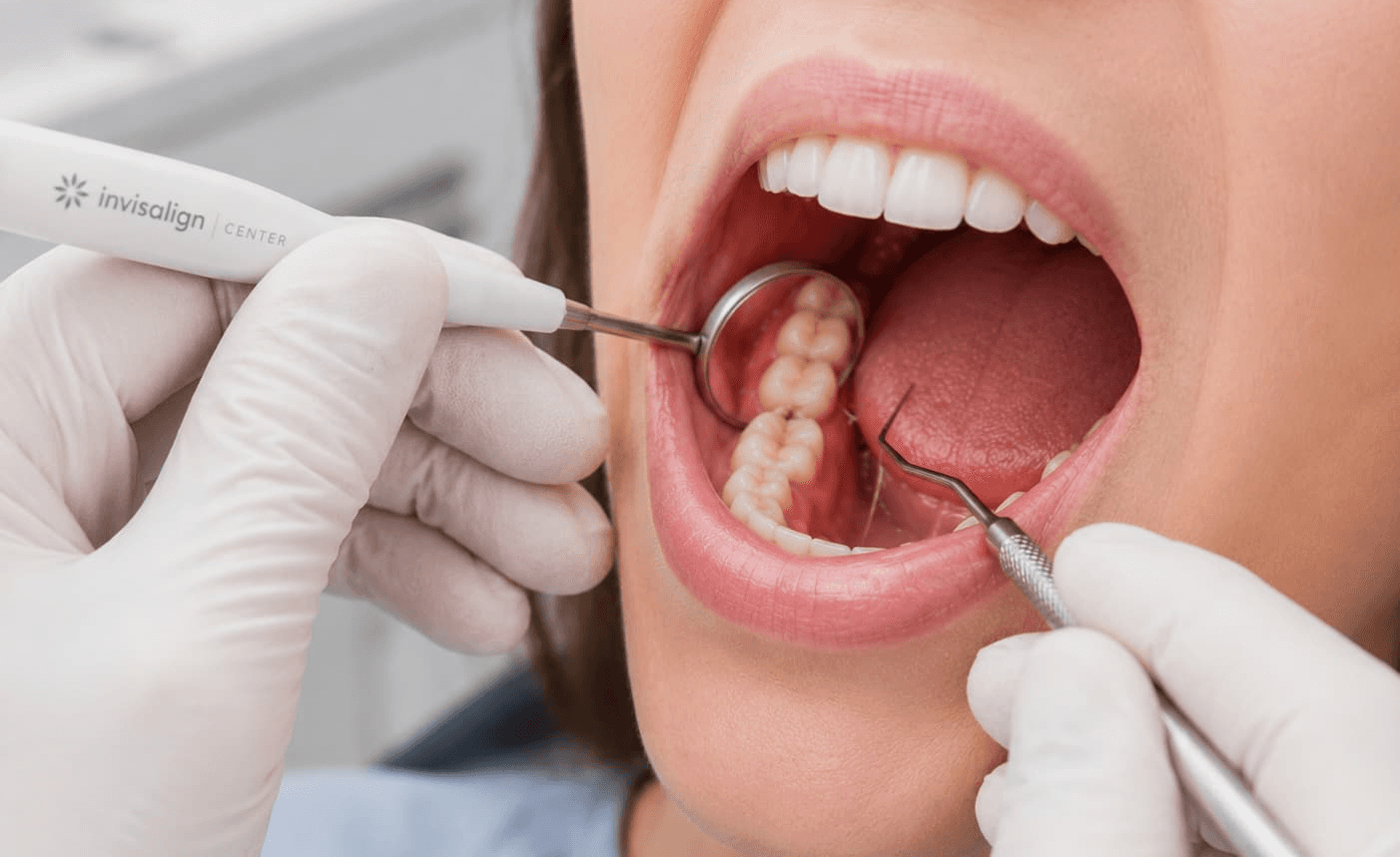 Dental examination of a partially erupted wisdom tooth associated with swollen gums at the back of the mouth.