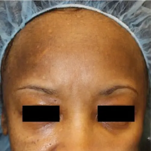Before pigmentation and discolouration treatment at The Vancouver Aesthetician — visible uneven skin tone, dark patches and pigmentation discolouration on skin