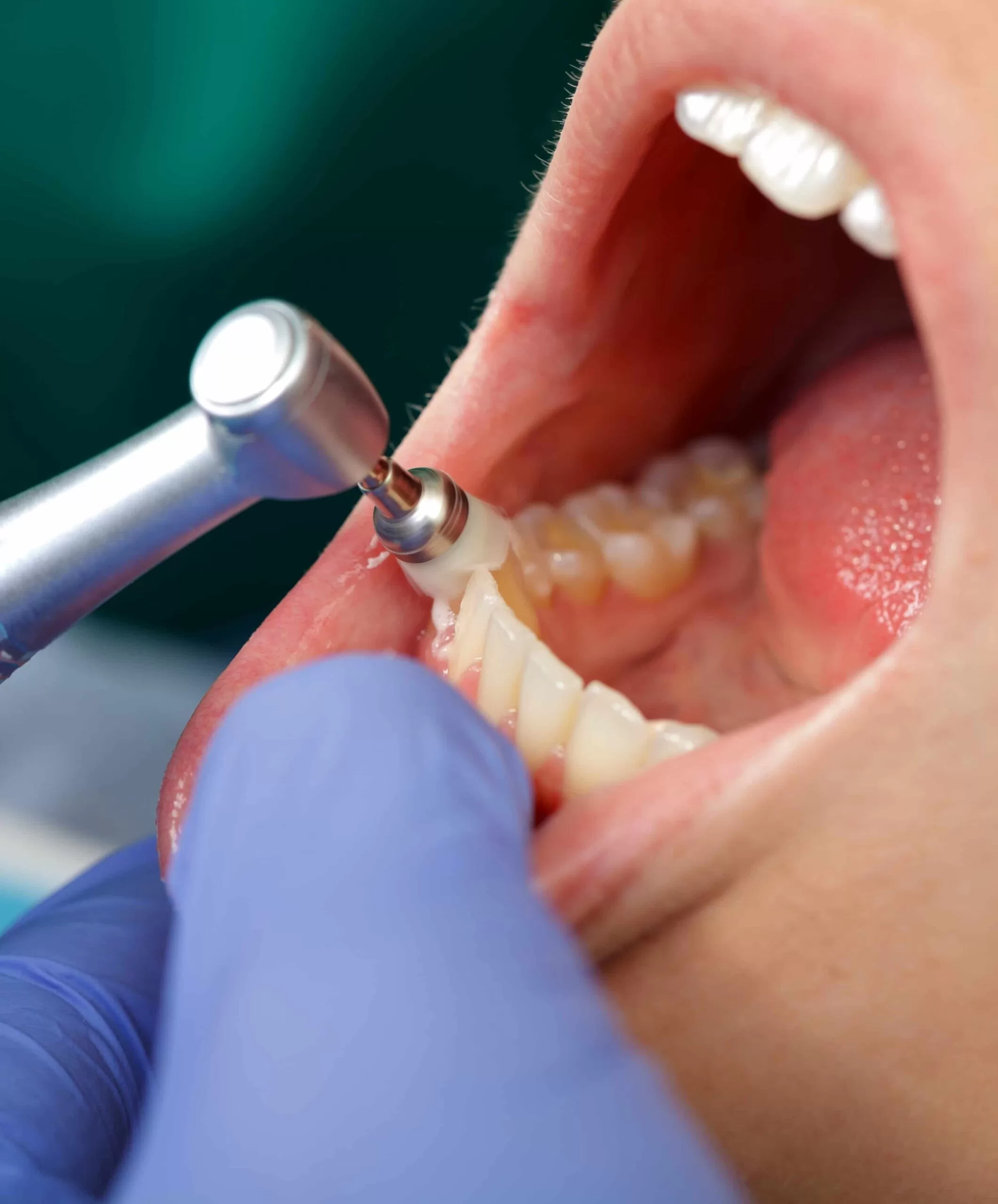 professional dental cleaning