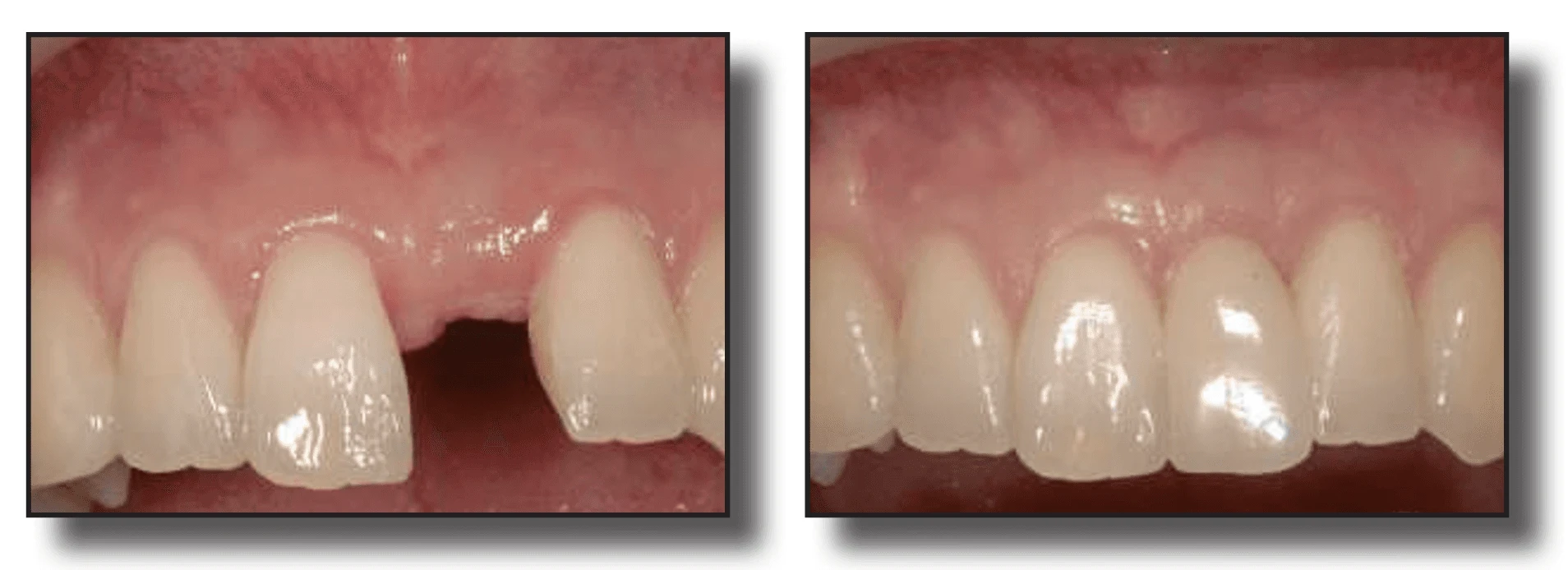Temporization: Post-Surgical Planning | Bloor-Yorkville Periodontics