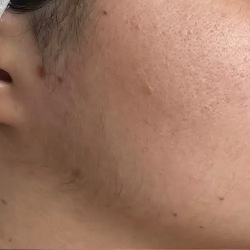 Before dermaplaning facial hair removal at The Vancouver Aesthetician — visible unwanted hair along the jawline and chin