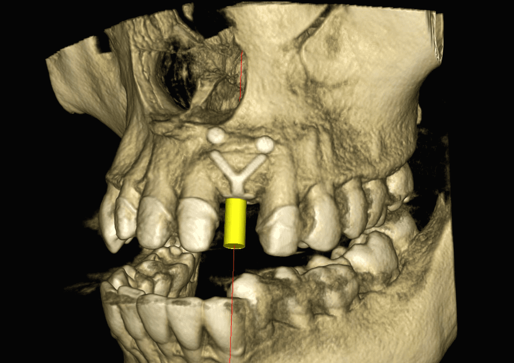 CBCT snímka s rideneou kostnou regeneráciou a plánovaným zavedením implantátu