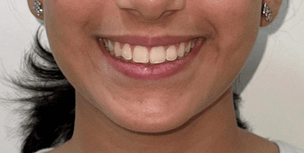 Teeth Whitening