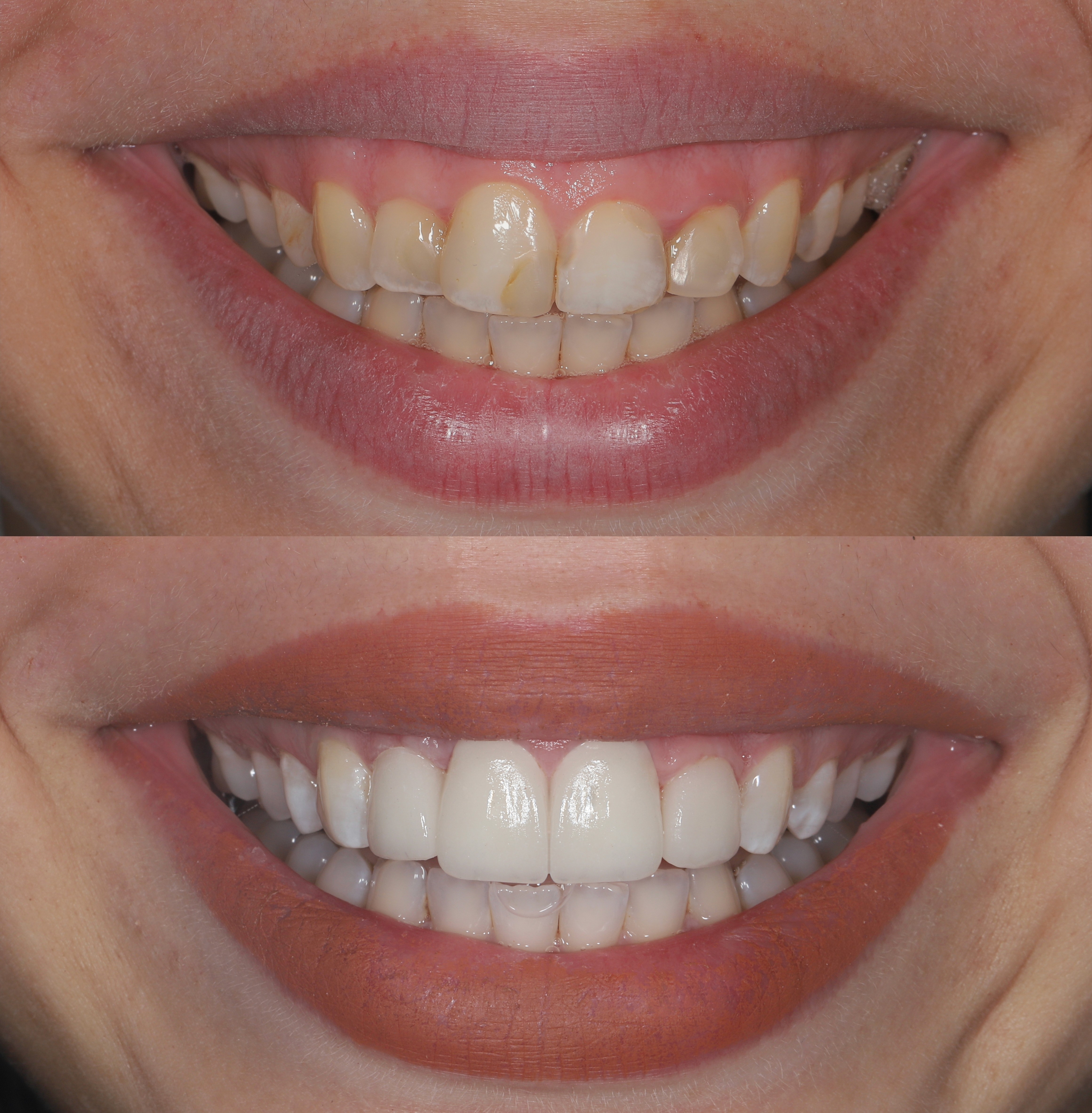 veneers right after the application, before-after to show the beautiful smile makeover at the invisalign center clinic in dubai