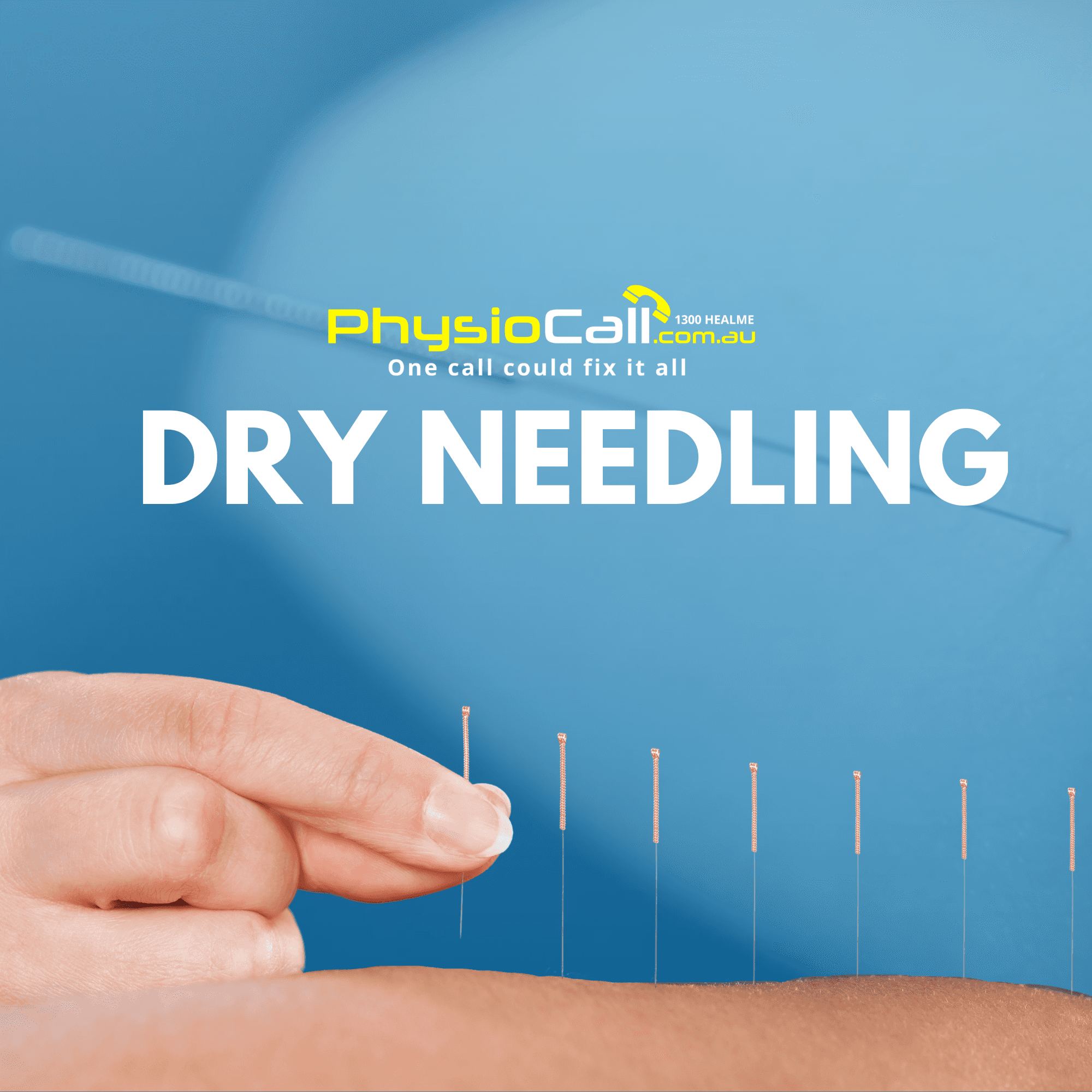 Dry Needling - Acupuncture