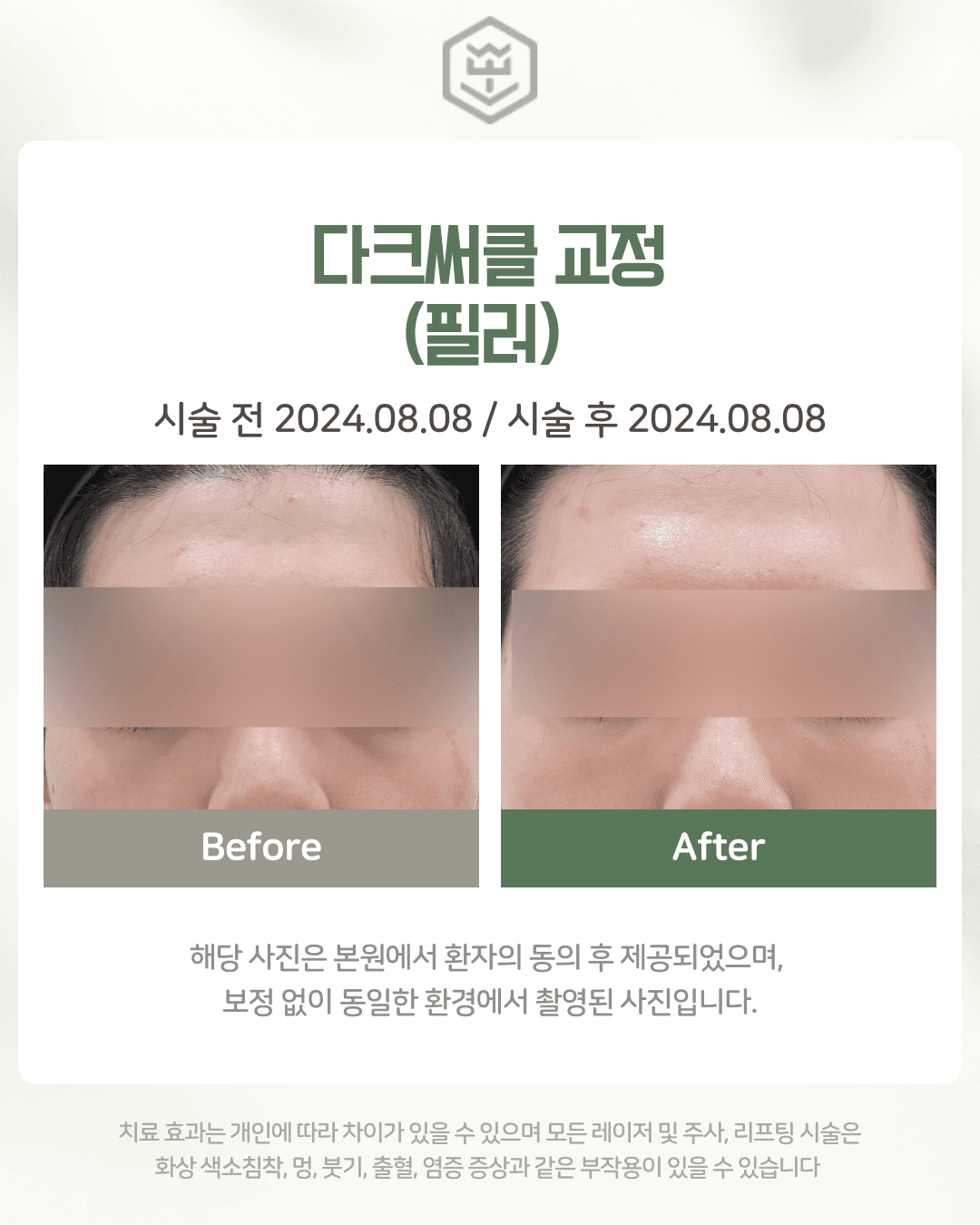 다크써클 교정(필러)