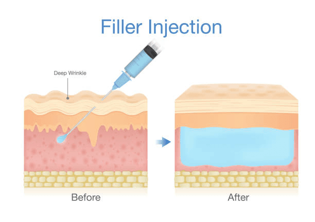 What Is a Hyaluronic Acid Dermal Filler?