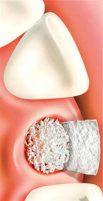 bone grafting in dentistry