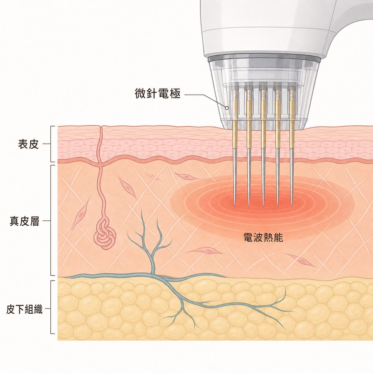 微針電波在真皮層釋放熱能的皮膚剖面示意圖