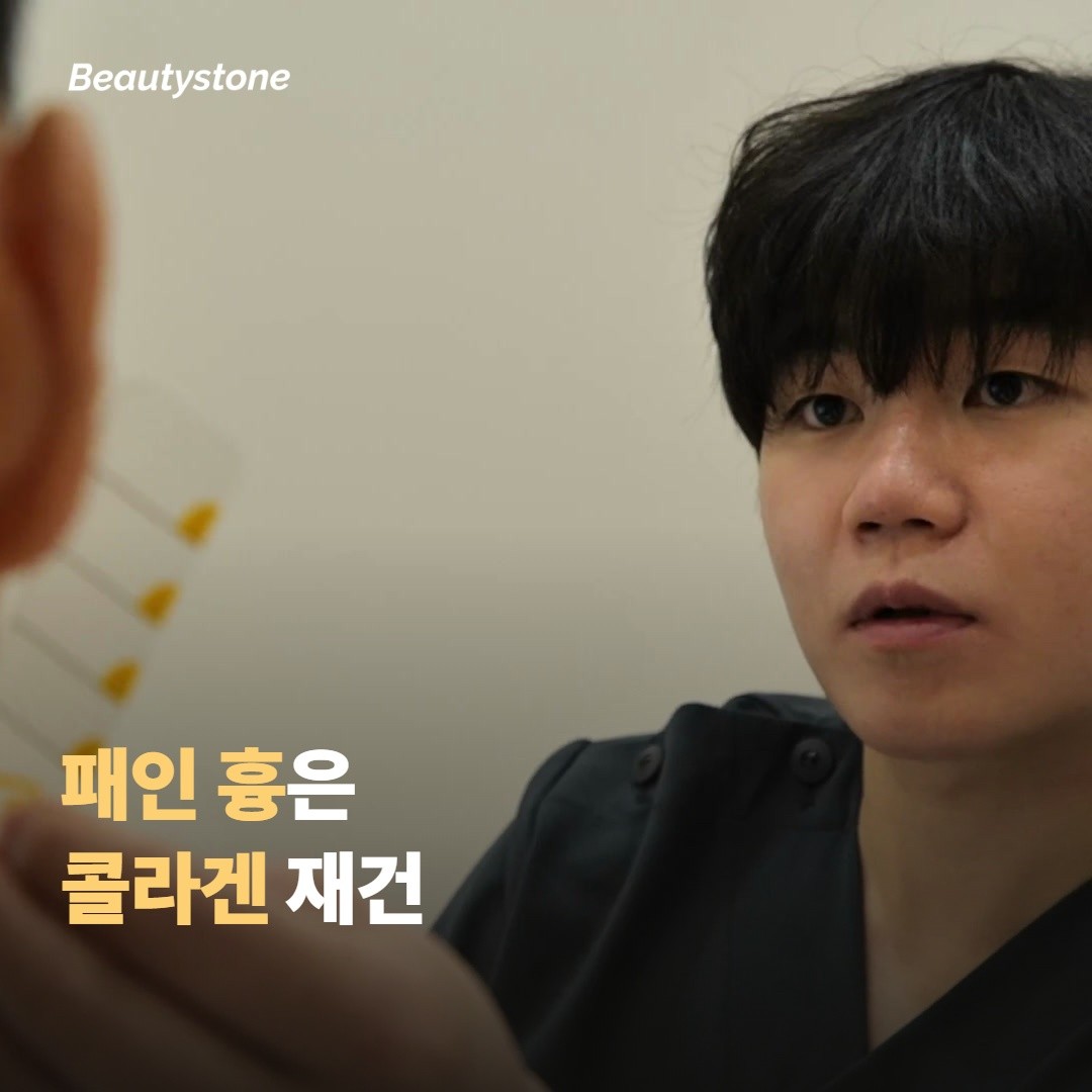 패인 흉(위축성)은 콜라겐 재건이 필요해요
