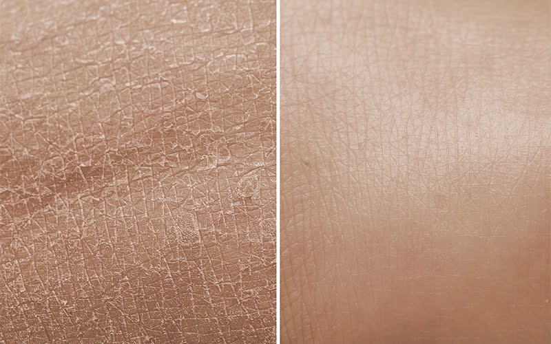 Side-by-side close-up images comparing dry, cracked skin (left) with smooth, healthy skin (right).