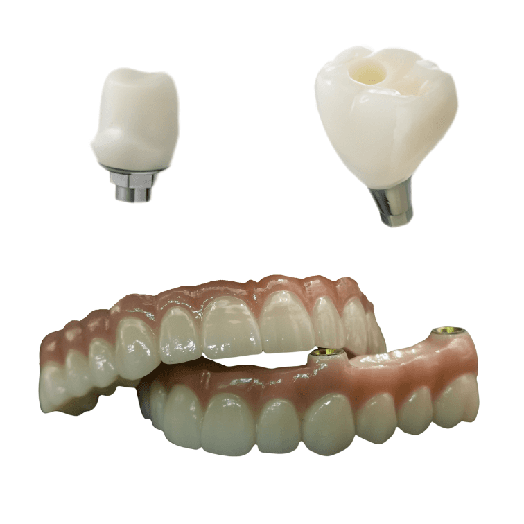 ivorymade implant crown and bridge