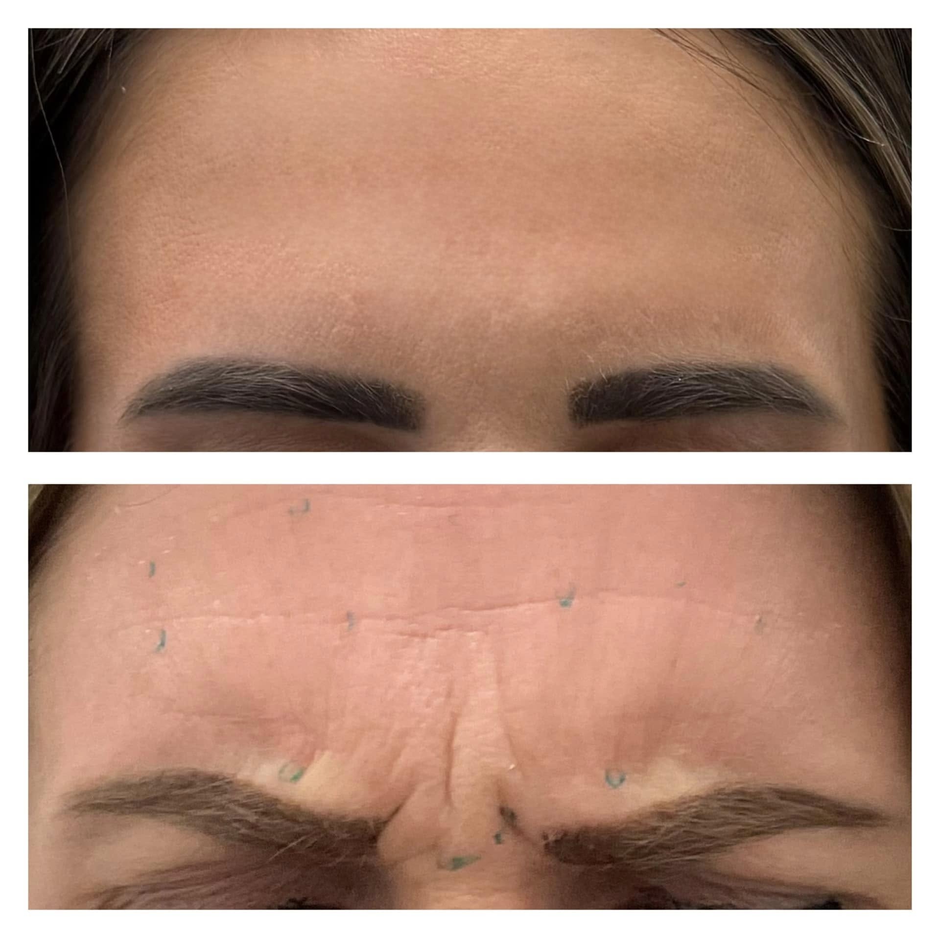 forehead botox hagerstown md