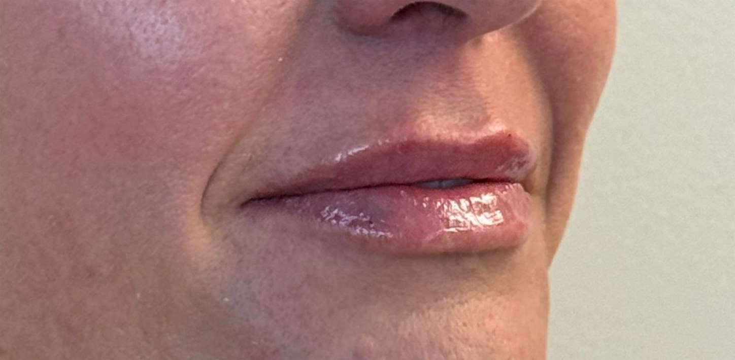 After: close-up of lips in profile.