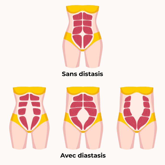 Schéma pour montrer les différents diastasis des grands droits