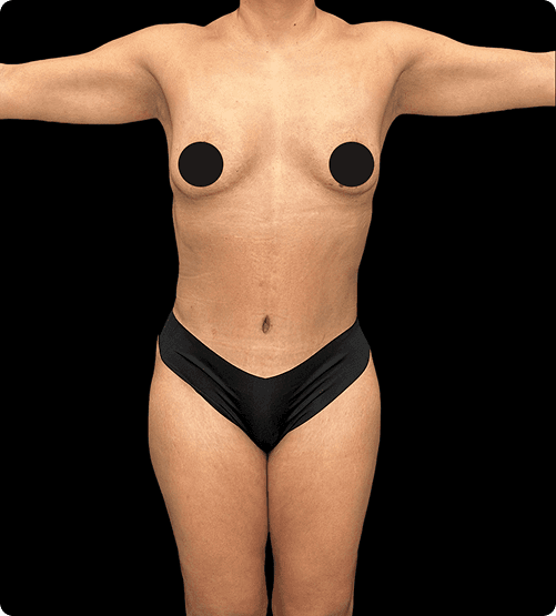 Después de la abdominoplastia en Mendoza Plastic Surgery en Atlanta – paciente 1