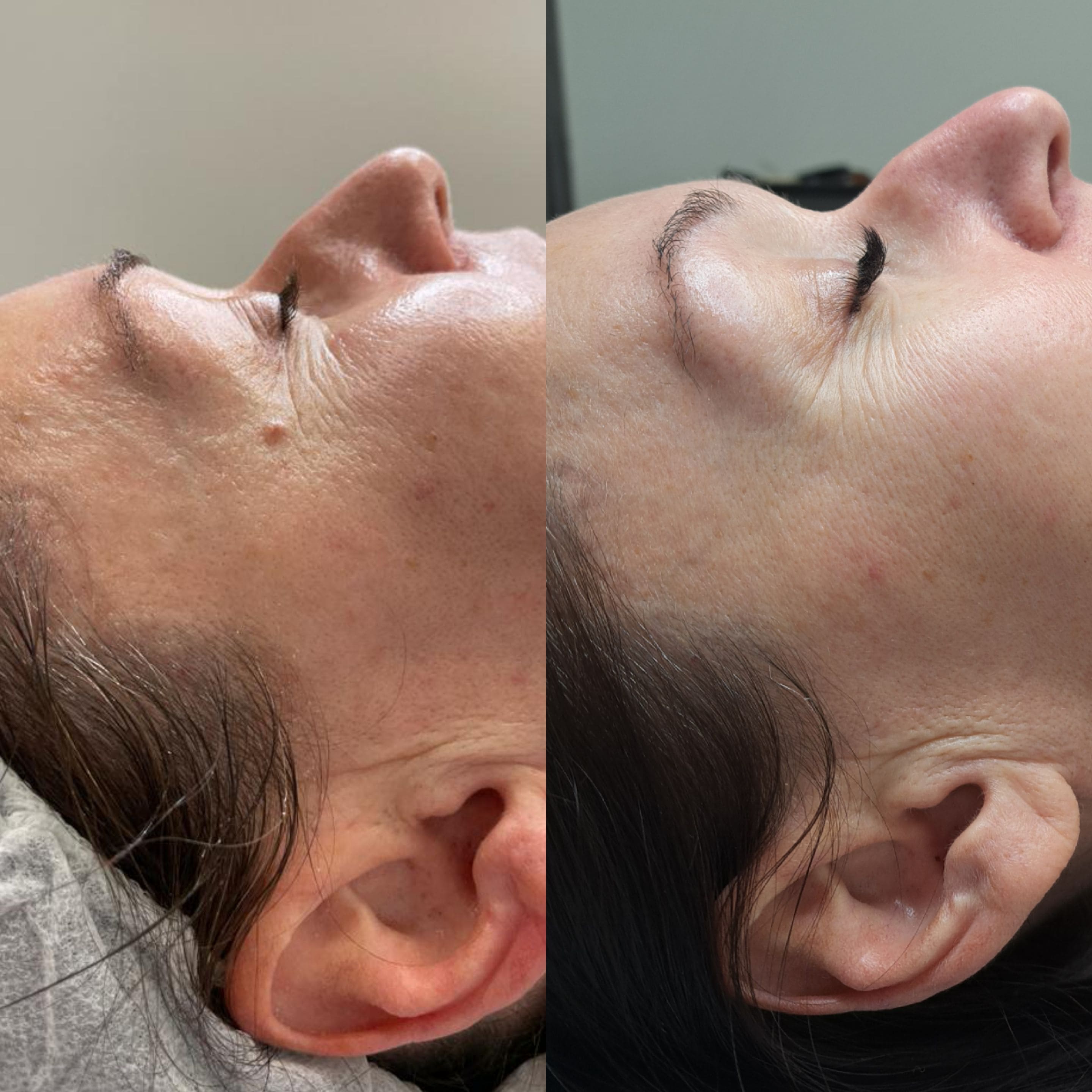 Fotodynamika estGen_zabieg_fototerapia_szczecin_efekty_leszczenko