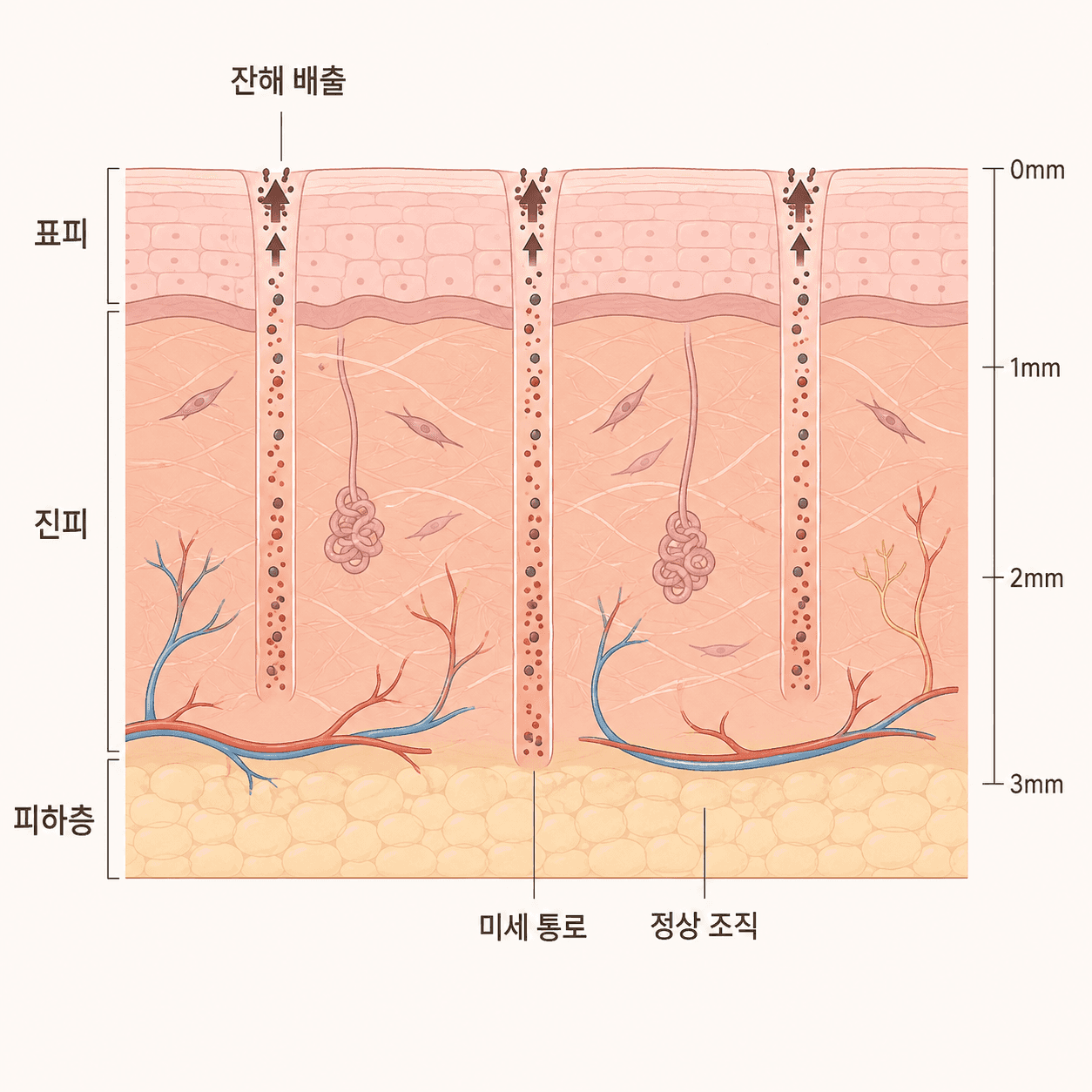미세 통로 사이에 정상 조직이 남아 있어 회복이 빠르게 진행돼요