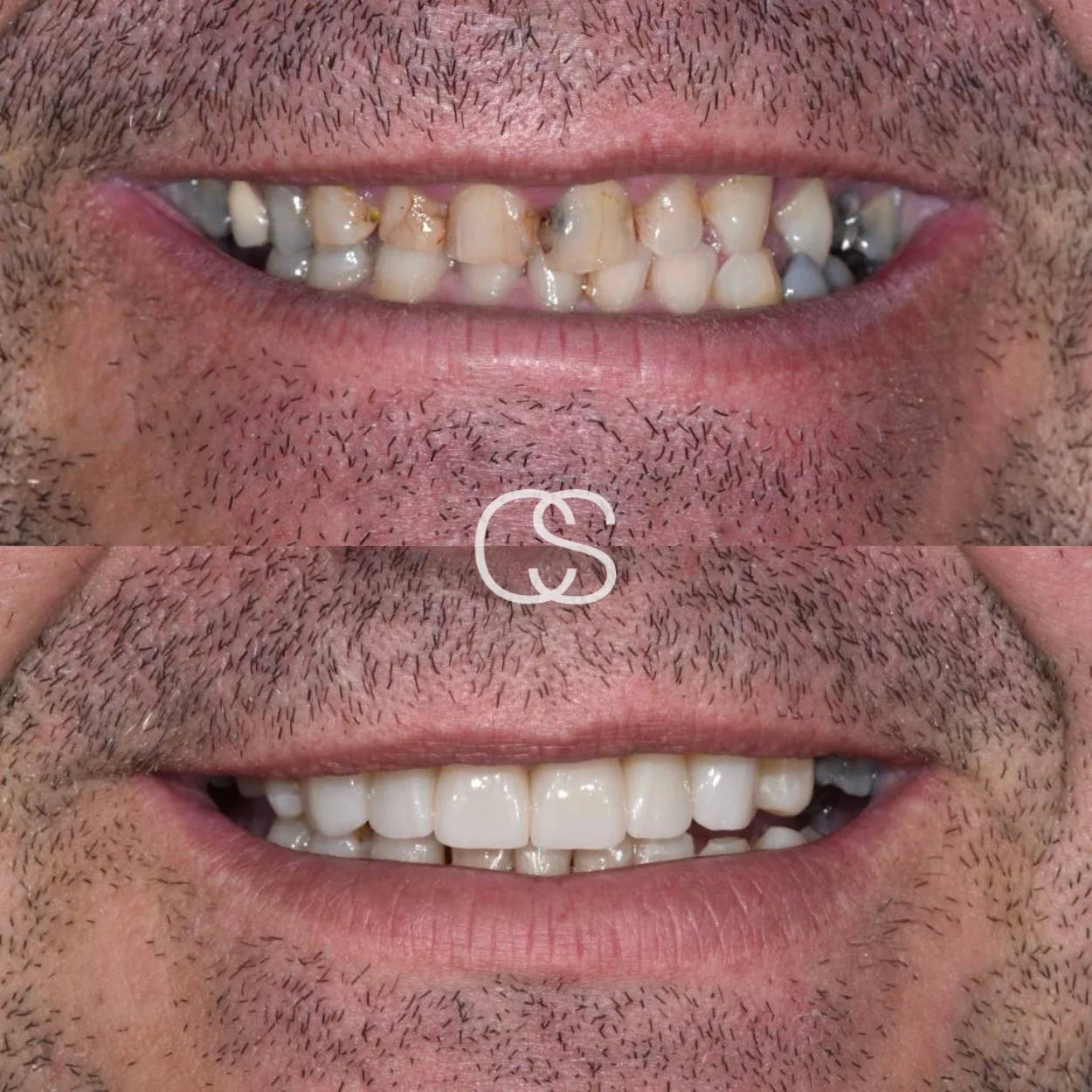 Before & After Teeth whitening, Colac Smiles, Colac