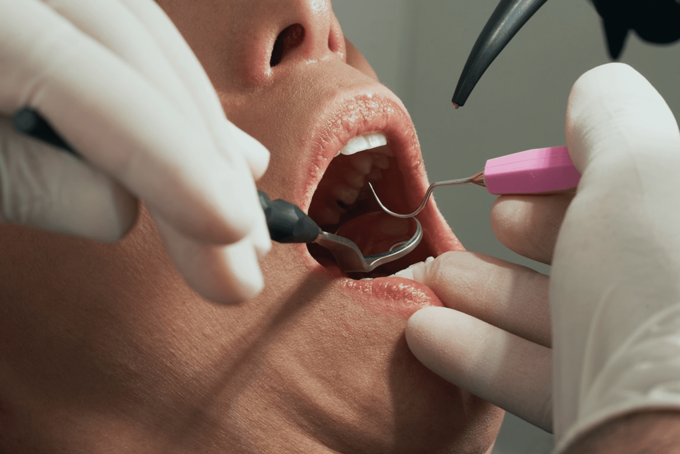 A dentist wearing gloves uses dental tools to examine a patient's open mouth, focusing on oral health care.